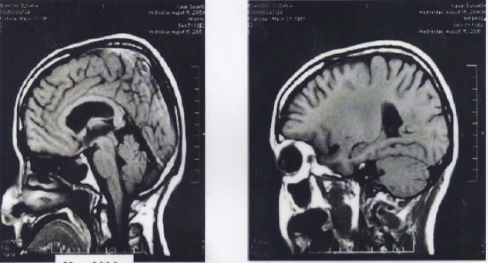 Degeneratie hersenen in 2006